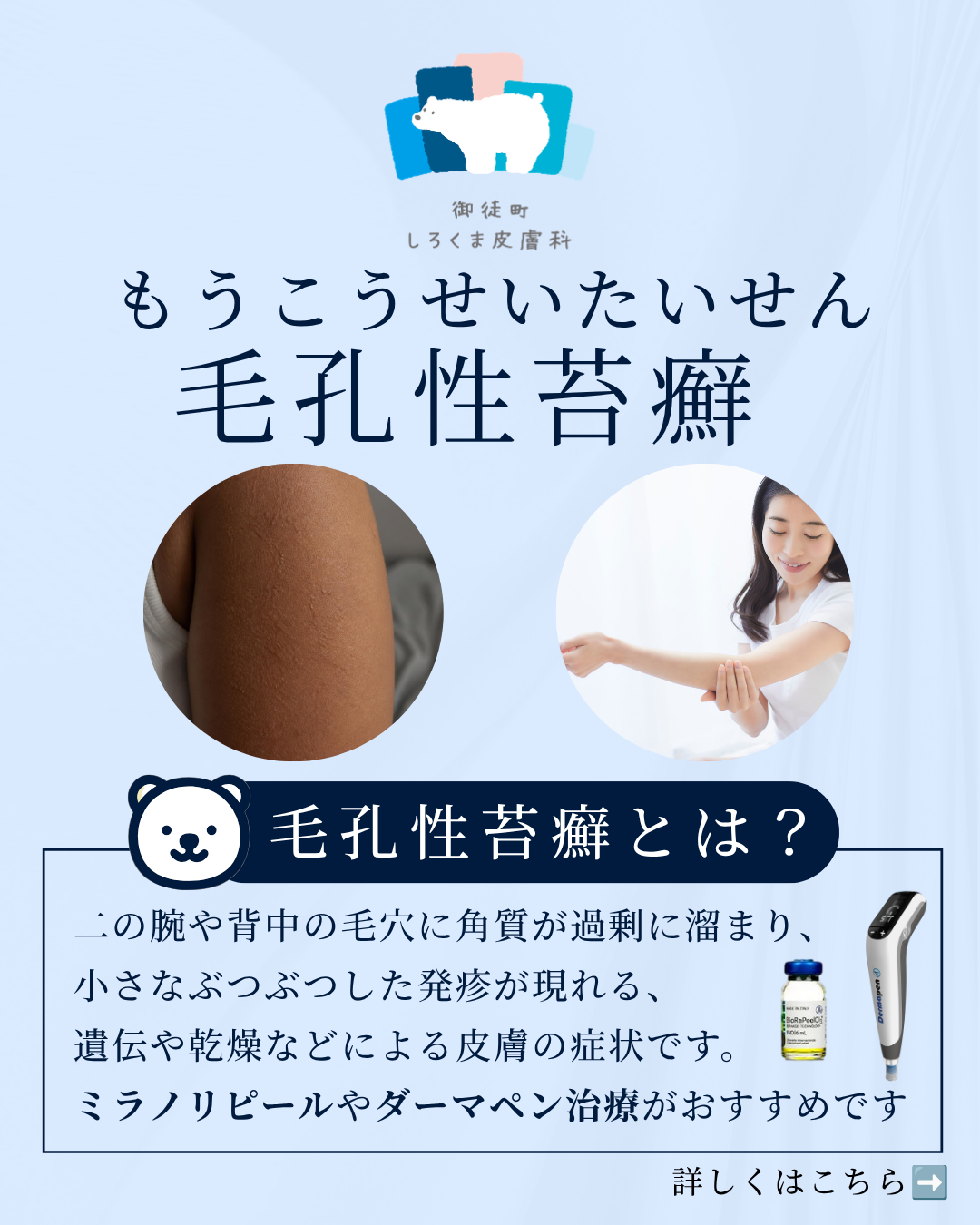 腕や背中のぶつぶつ：毛孔性苔癬（もうこうせいたいせん）